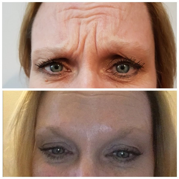 Botox Anti-Wrinkle Injections in Lichfield & Staffordshire | JacMe Oral Care Facial Aesthetics