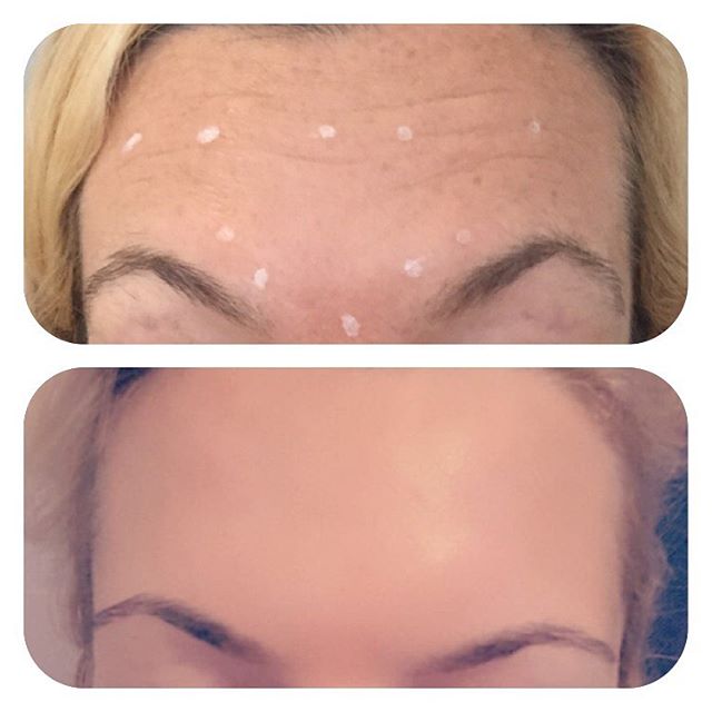Botox Anti-Wrinkle Injections in Lichfield & Staffordshire | JacMe Oral Care Facial Aesthetics