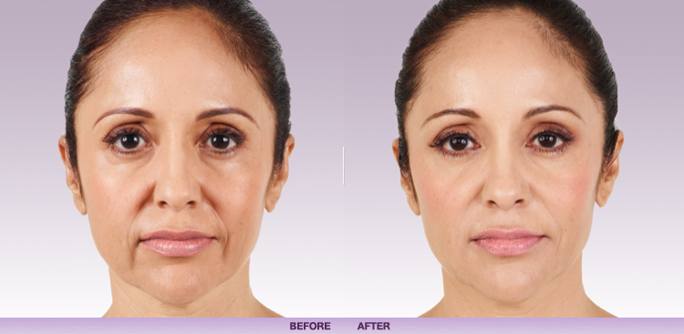 Dermal Fillers in Lichfield & Staffordshire | JacMe Oral Care Facial Aesthetics 